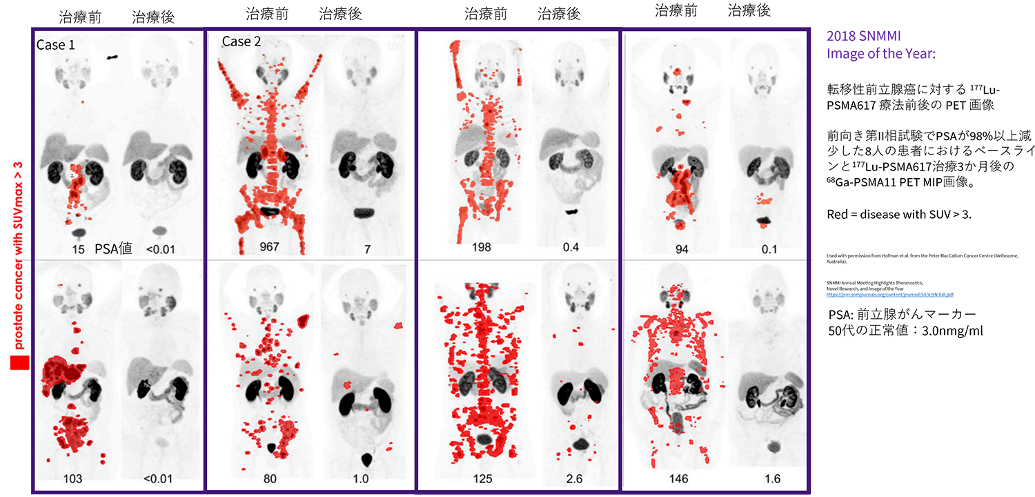 放射性リガンド療法(Radio Ligand Therapy)とは?